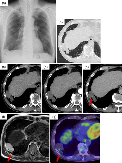 Figure1 Radiologic Findings In A 76 Year Old Man With Primary Pulmonary Download Scientific