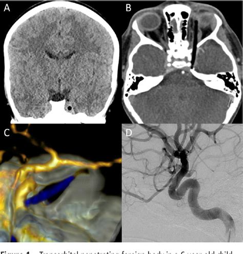 Figure 1 From Cavernous Sinus Embolisation Prior To Removal Of Penetrating Foreign Body In A 6