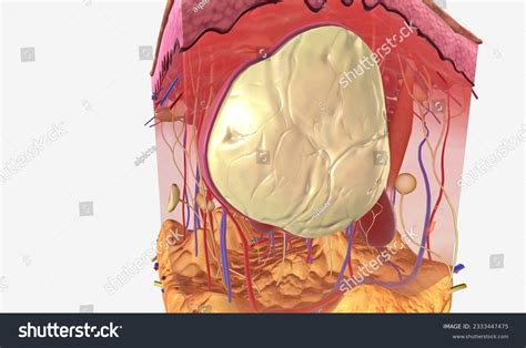 Sebaceous Cyst: Over 59 Royalty-Free Licensable Stock Illustrations & Drawings | Shutterstock