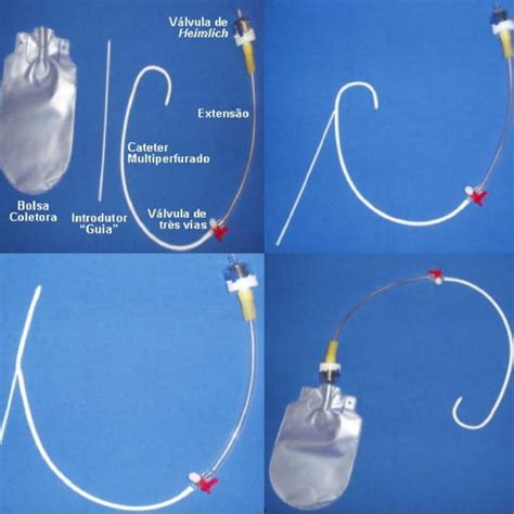 Pdf Pleurodesis Technique And Indications [pleurodese Técnica E Indicações]