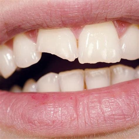 Need A Chipped Tooth Repaired Call Excellence In Dentistry To Restore Your Smile Excellence