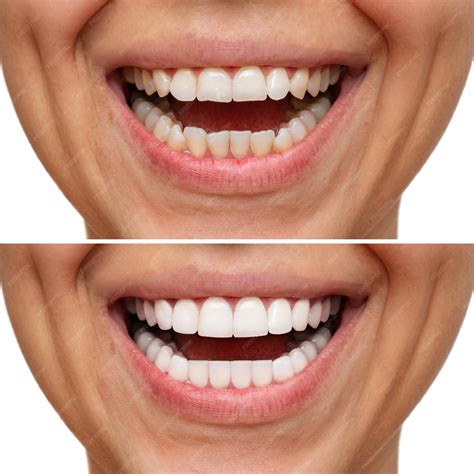 Teeth Veneers Before And After