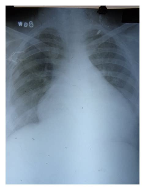 Chest X Ray Showing Increased Cardiothoracic Ratio And Prominent Left Download Scientific