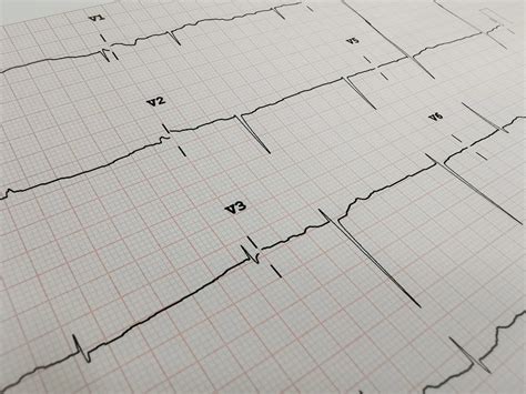 Atrial Fibrillation Treatment in Chandler, AZ