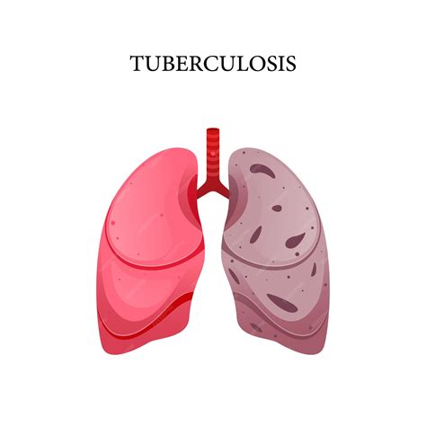 Premium Vector Tuberculosis Disease Vector Illustration Design For