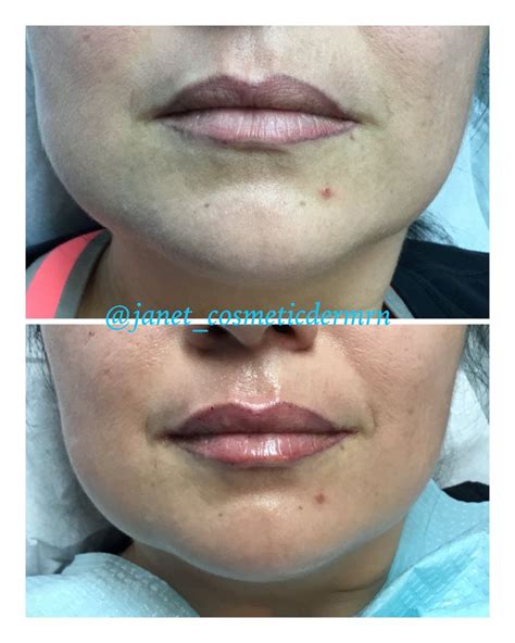 Pin On Lips Enhancement Lip Enhancement Enhancement Lips