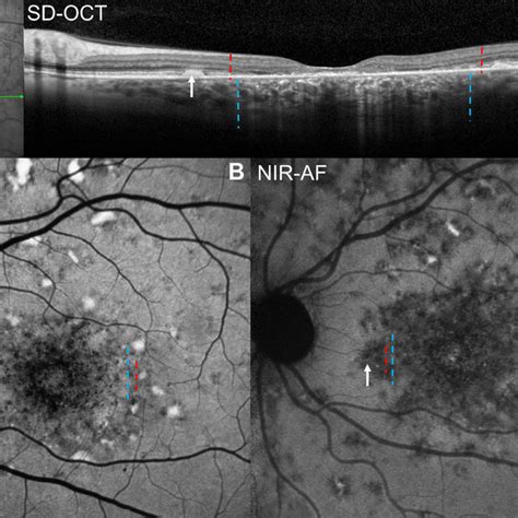 Multimodal Fundus Images Group P A Sd Oct And Ir R The Green