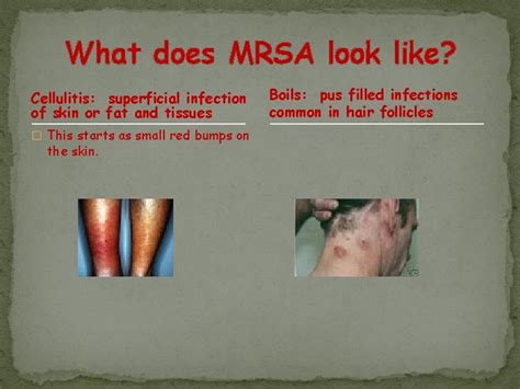 Mrsa Methicillin Resistant Staphylococcus Aureus How Many Kinds