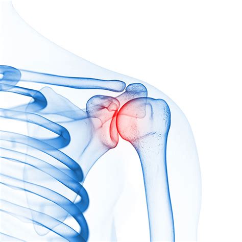 Shoulder Arthritis | Keystone Physiotherapy