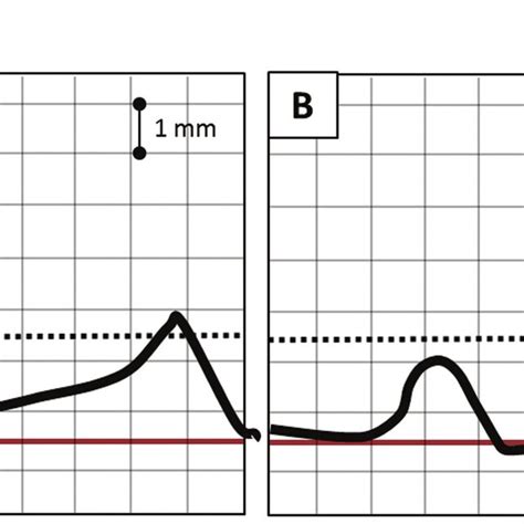 A Ecg Of Early Repolarization And A Rapidly Ascending Upward Sloping