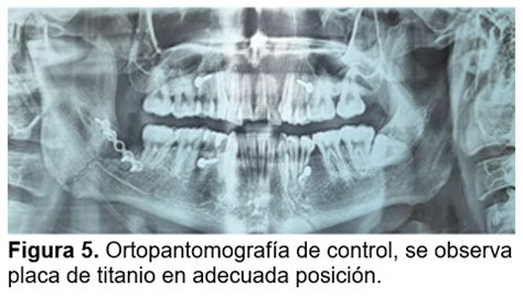 Infección como complicación de una fractura de ángulo mandibular