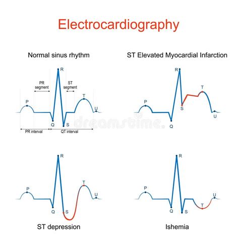 Ecg Of A Heart In Normal Sinus Rhythm Stock Vector Illustration Of