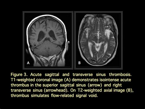 MRI BLOG: Dural Sinus Thrombosis