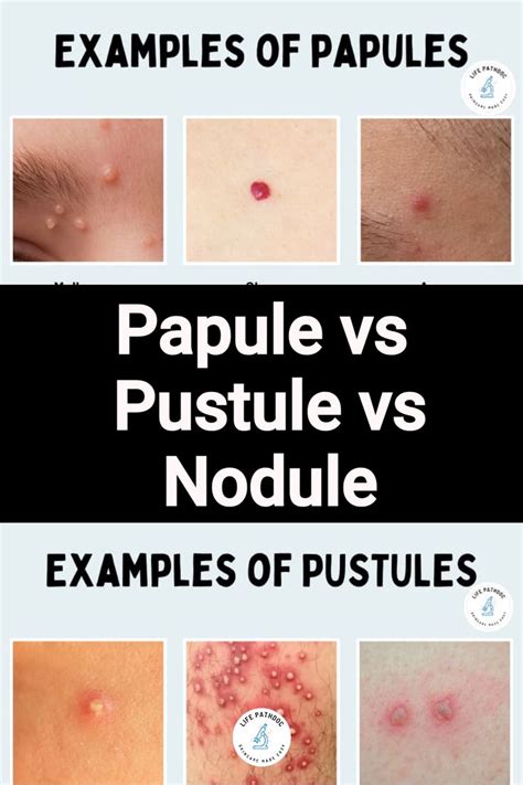 Papule vs Pustule vs Nodule: Pictures, Differences, and Causes i 2024