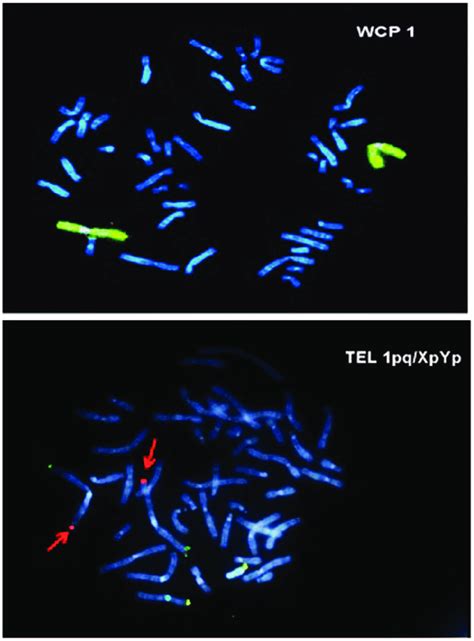 Fluorescent In Situ Hybridization Analysis Showing Heterozygotic