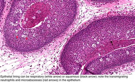 Inverted Papilloma C82