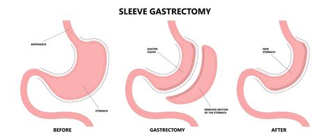 Completetotal Gastrectomy