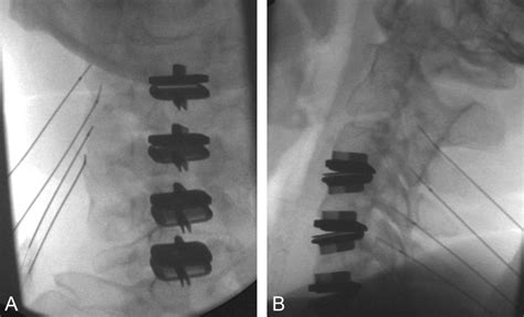 Role Of Facet Joints In Spine Pain And Image Guided Treatment A Review