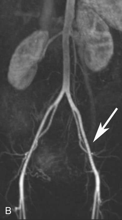 Contrast Enhanced Magnetic Resonance Angiography Radiology Key