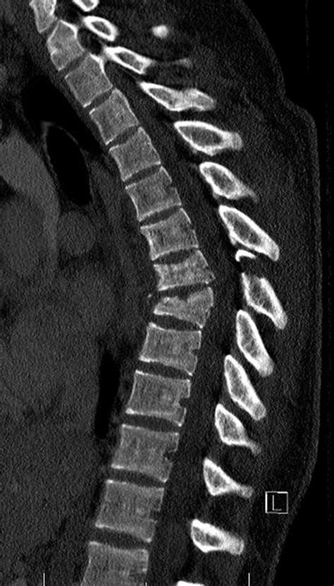 Posterior Thoracic Fusion For Flexion Distraction Injury