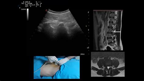 Ultrasound Guided Transforaminal Epidural Steroid Injection Youtube