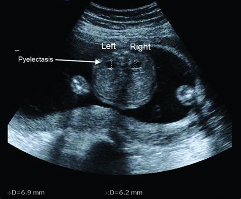 Genetic Sonogram Components And Role In The Era Of Prenatal Screening Fetal And Maternal