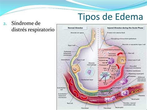 Ppt Esclerosis Vascular Embolia Pulmonar Hipertensión Pulmonar Edema Pulmonar Powerpoint