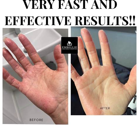 Dry Hands Before And After Ubicaciondepersonas Cdmx Gob Mx