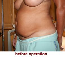 Tummy Tuck Abdominoplasty Body Contouring Photo Gallery By Phuket