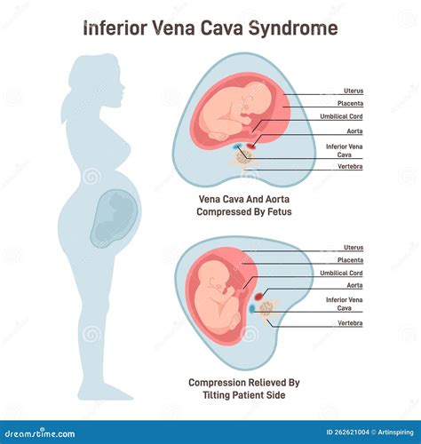 Inferior Vena Cava Syndrome. Pregnant Woman Has A Compression Vector ...