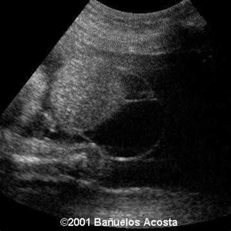 📃 Omphalocele