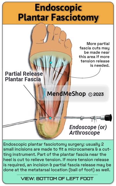 Types of Surgery For Plantar Fasciitis & Other Foot Injuries