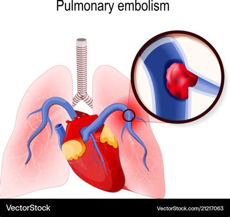 Pulmonary Embolism Royalty Free Vector Image VectorStock