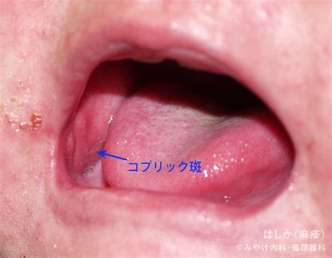 はしか（麻疹） ｜ よく見られる子どもの病気 みやけ内科・循環器科【家庭の医学】