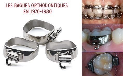 Orthodontie Linguale En France Et Ile De France Historique Et