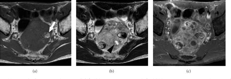 Figure 1 From A Case Of Pelvic Schwannoma Presenting Prominent Eggshell