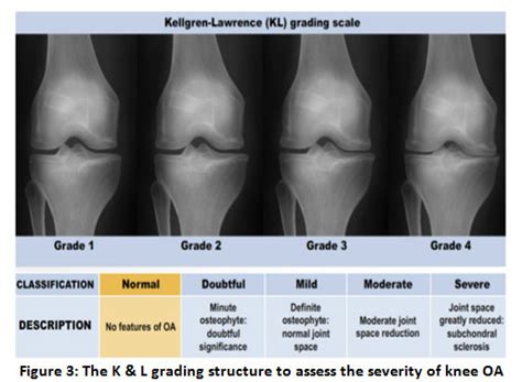 An Overview Of Medical Imaging Techniques For Knee Osteoarthritis