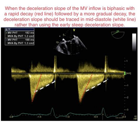 Ritu Thamman Md On Twitter When The Deceleration Slope Of The Mv