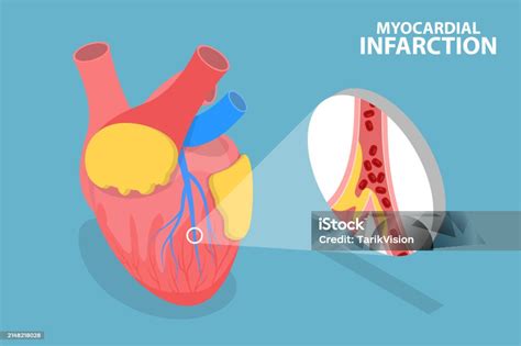 3d Isometric Flat Vector Conceptual Illustration Of Myocardial