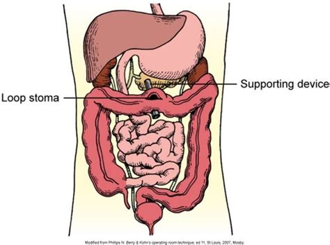 Nsg Exam Elimination Urinary And Bowel Flashcards Quizlet