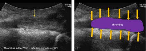 Deep Vein Thrombosis DVT Review Of DVT Assessment Can We Assess