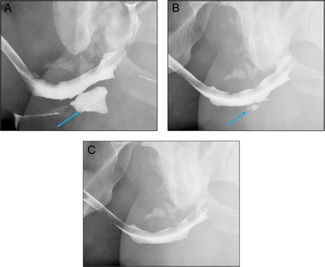 Anterior Urethral Strictures And Retrograde Urethrography An Update For Radiologists Clinical