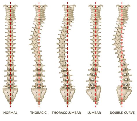 Scoliosis Treatment In Santa Clara Hoewisch Chiropractic