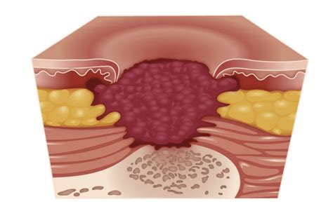 Skin Ulcer(Bedsore) Stages: How It Ruins Your Skin - Voibon Blog