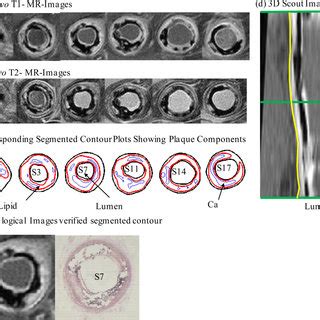 Overview Of 3D FSI Solution Behaviours Based On MR Images Of The Plaque