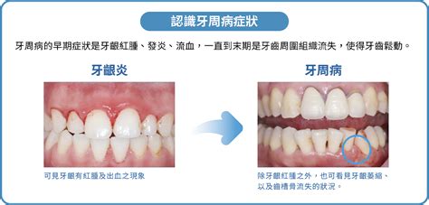 牙周病防治正確潔牙一輩子的功課