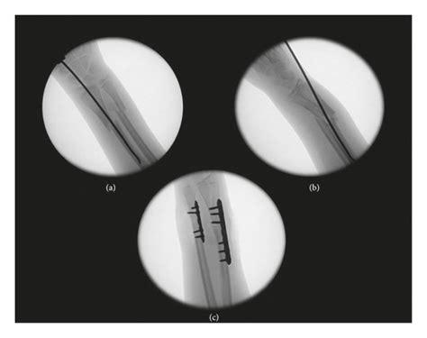 A B Intraoperative Fluoroscopic Images Showing Two Views Of Flexion