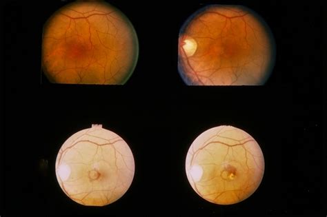 Central Serous Retinopathy - Retina Image Bank