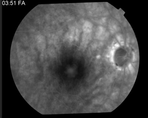 Adult Foveomacular Vitelliform Dystrophy - Retina Image Bank