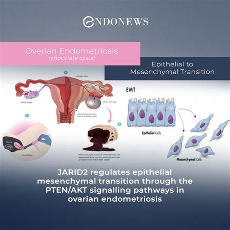 Molecular Alterations In Ovarian Endometriosis Endonews